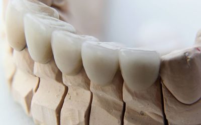 What Factors Influence Dental Crown Cost in South Austin?