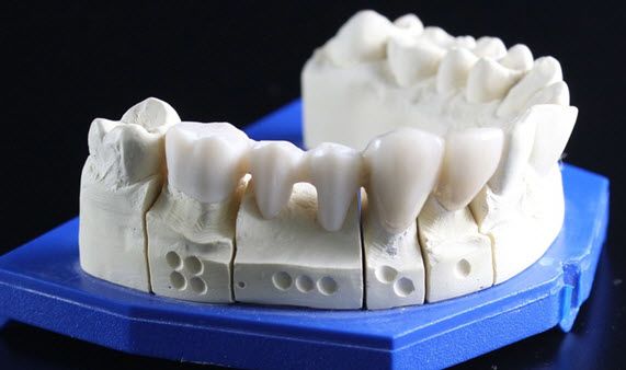 The Variations of Dental Crowns Offered in South Austin