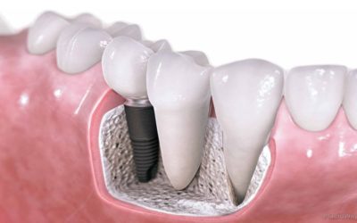 Dental Implants: Should you Get One?